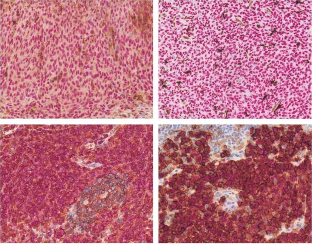 Dual chromogenic immunohistochemical staining of FFPE tumor samples